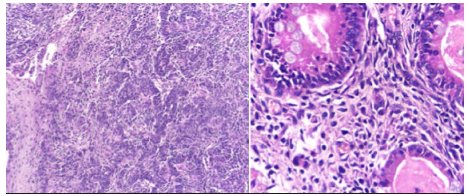 A Sertoli Leydig Tumor In An Year Old Patient Grem Gynecological