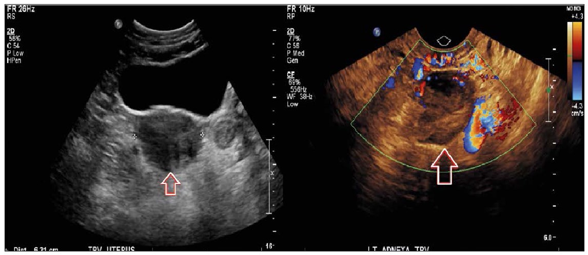 Exceptional Association Of Leydig Cell Ovarian Tumor And Primary