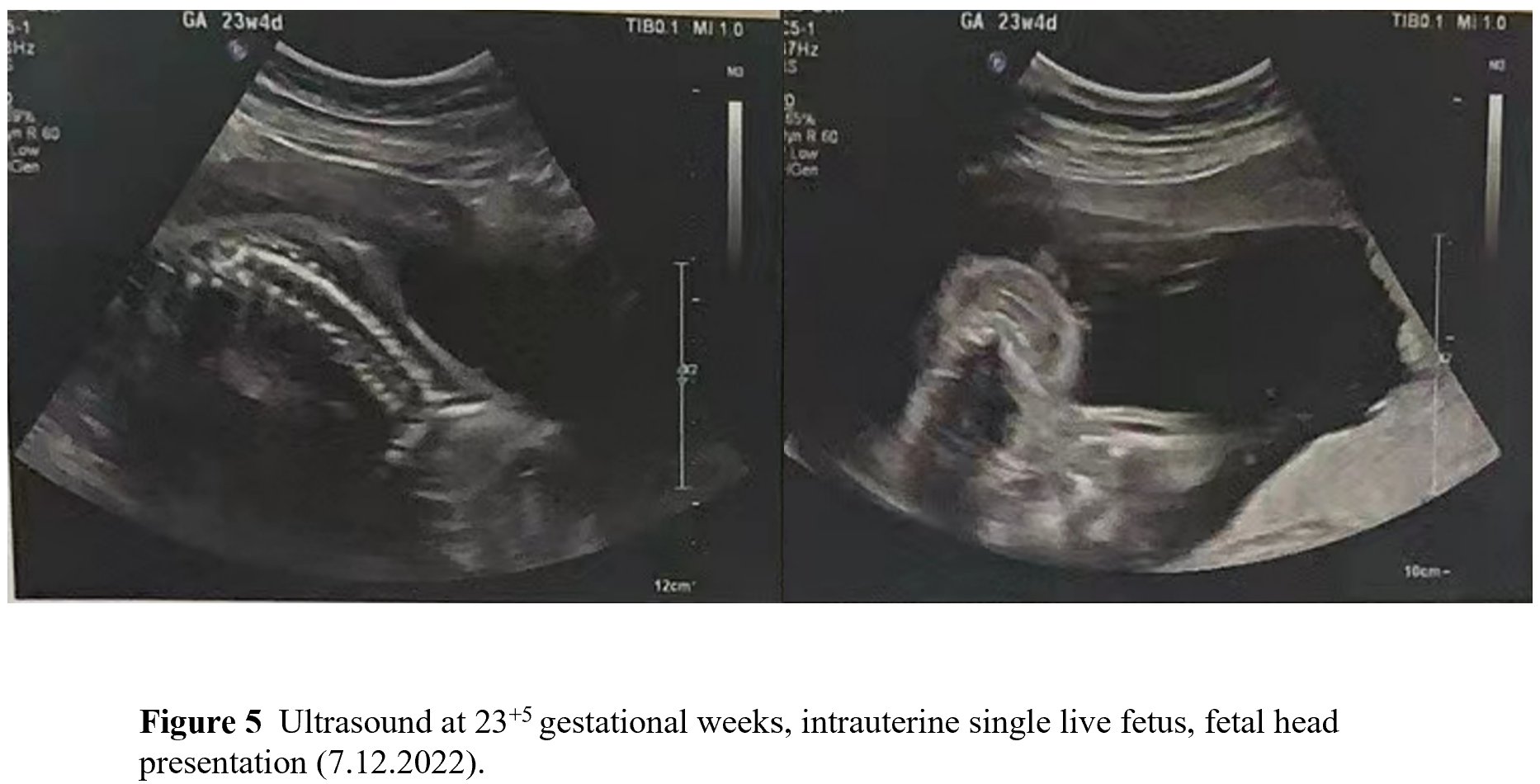 A case of primary hypothalamic pituitary amenorrhea in a woman treated ...